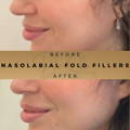 Nasolabial Fold Fillers Wilmslow