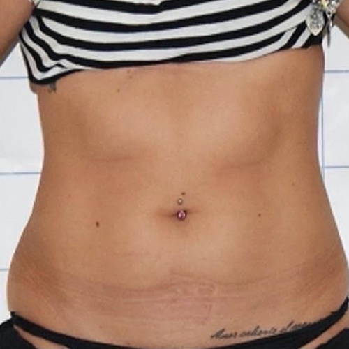 Dr Sknn Non-Surgical Fat Reduction, Cellulite & Skin Tightening Before