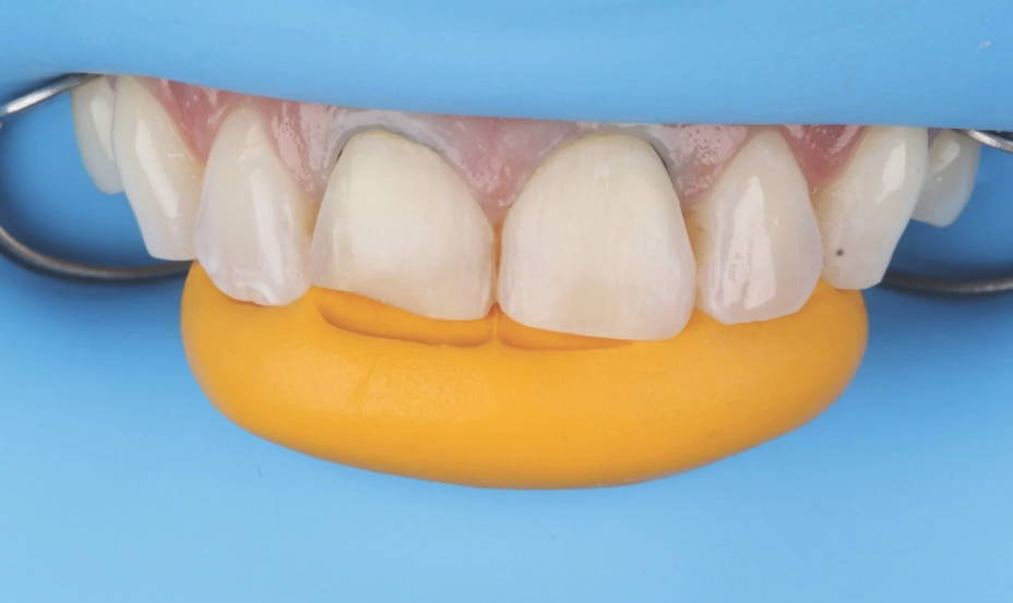 PVS matrix fitted for tooth preparation