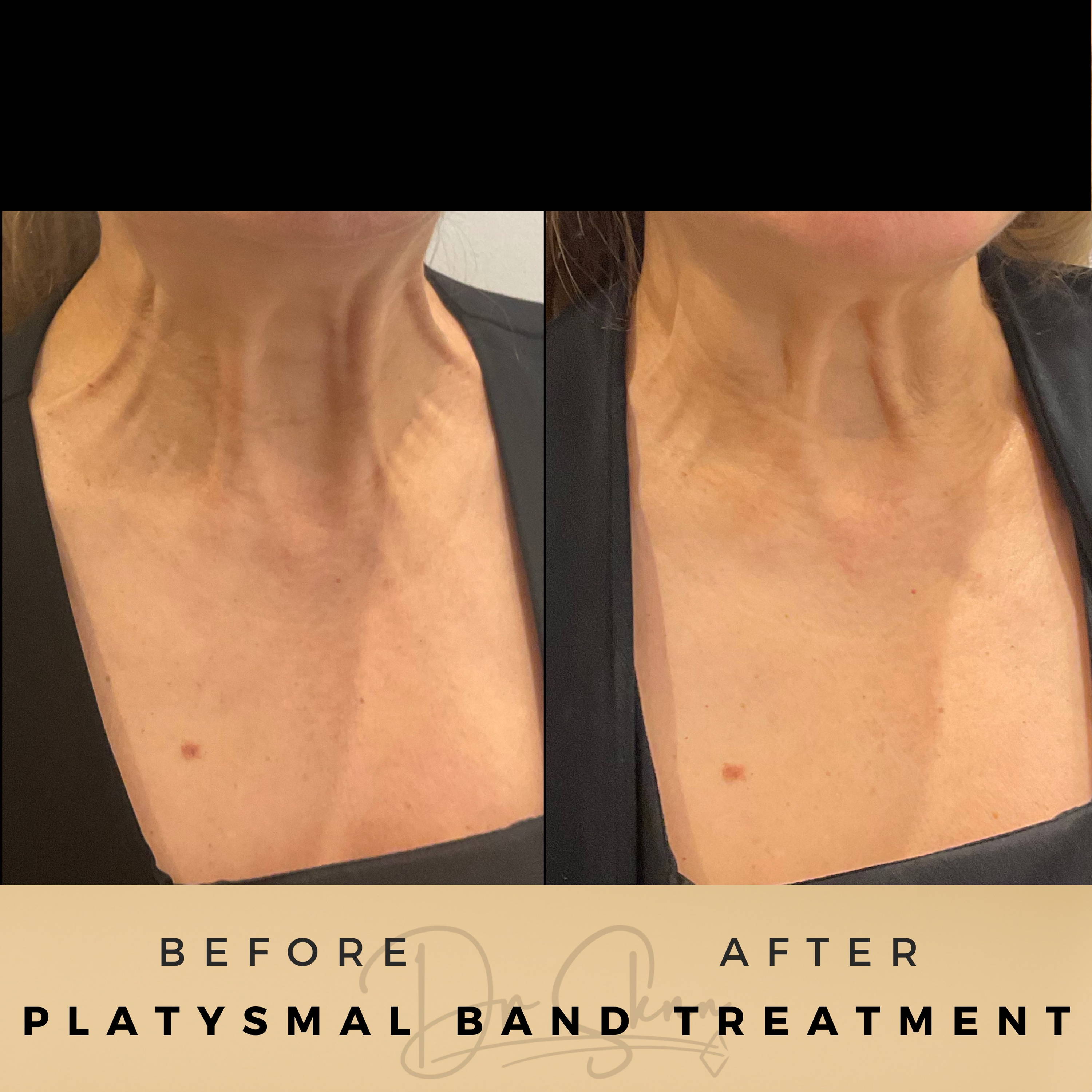 Platysmal Bands Wilmslow Before & After Dr Sknn