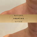 TrapTox Wilmslow Dr Sknn Before & After Picture