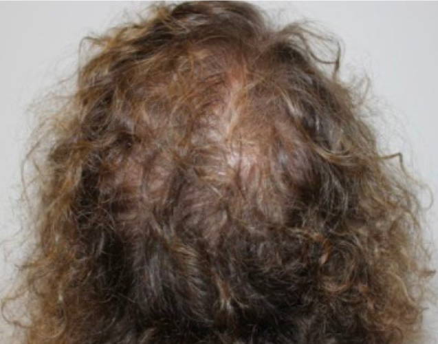 Dr Sknn Hair Restoration Before