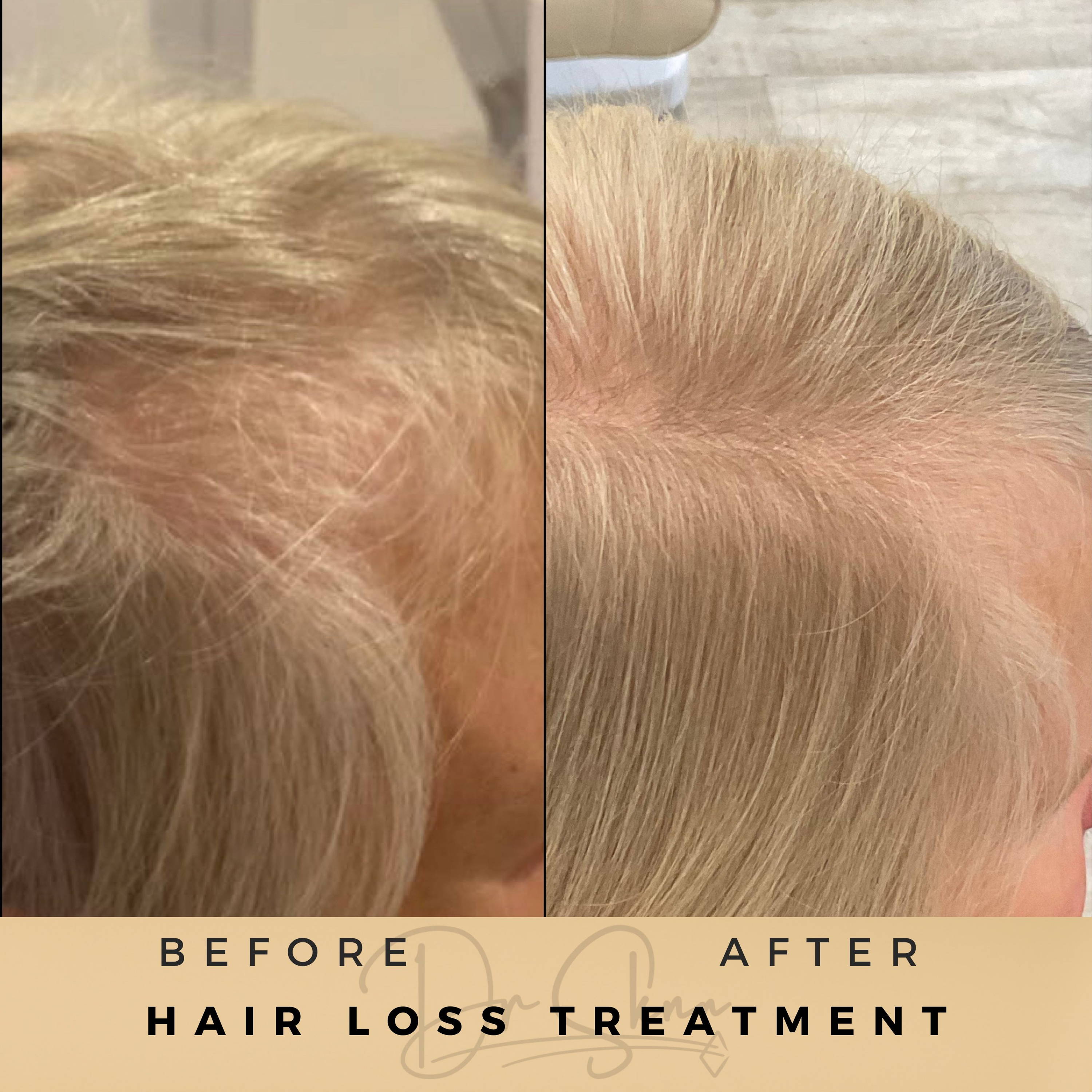 Hair and scalp at Dr Sknn Wilmslow