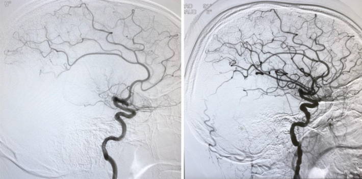 thrombectomy image before and after