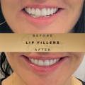 Lip Fillers Wilmslow with Anti-wrinkle injections