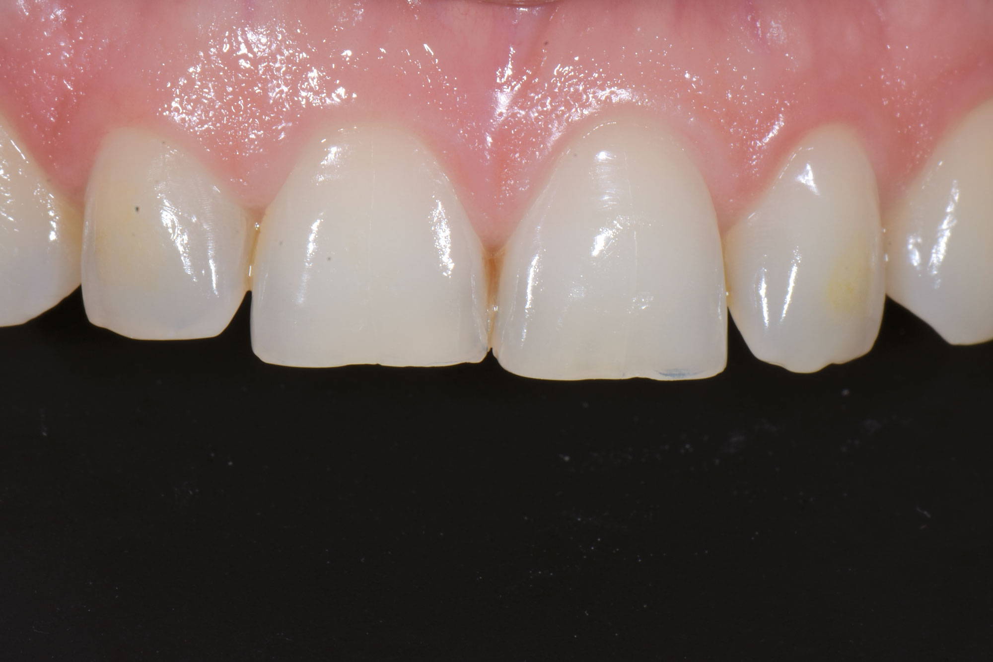 upper teeth before restoration in black background