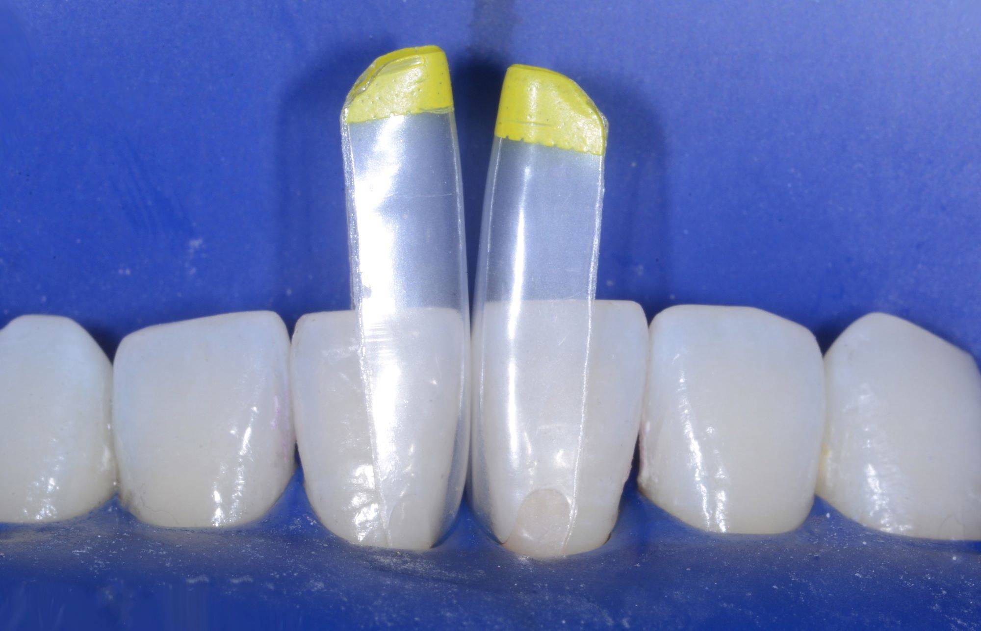 Yellow matrices placed in rubber dam isolated teeth