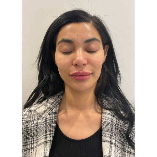 LIP FILLER AFTER