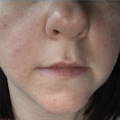 INTENSE PULSED LIGHT (IPL) - LIGHT ASSISTED ACNE TREATMENT Before picture