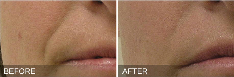 Dr Sknn Hydrafacial Before & After Picture