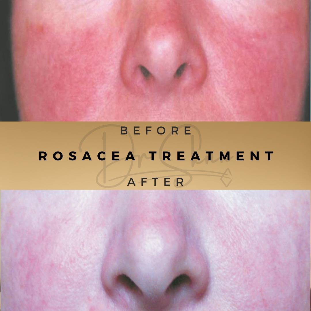 Rosacea Treatment Wilmslow Before & After Dr Sknn