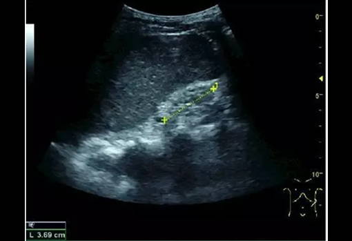 End-stage renal disease image scanned by EagleView portable ultrasound.