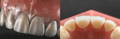 Anterior teeth covered in silver powder & Lower view of anterior tooth
