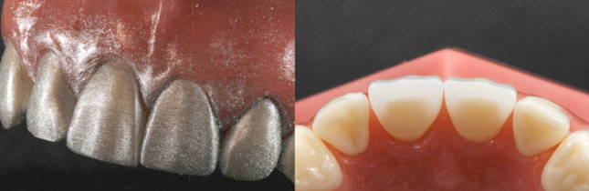 Anterior teeth covered in silver powder & Lower view of anterior tooth