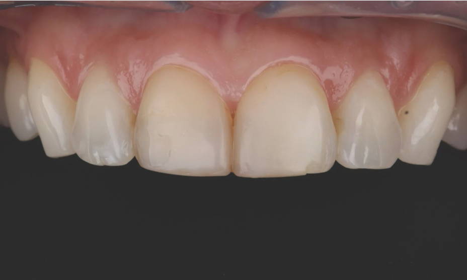 smile pre-restorarion