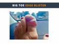 Big toe edge blister