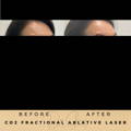 Pigmentation Treatment Co2 Fractional Laser Wilmslow Dr Sknn Before & After Picture