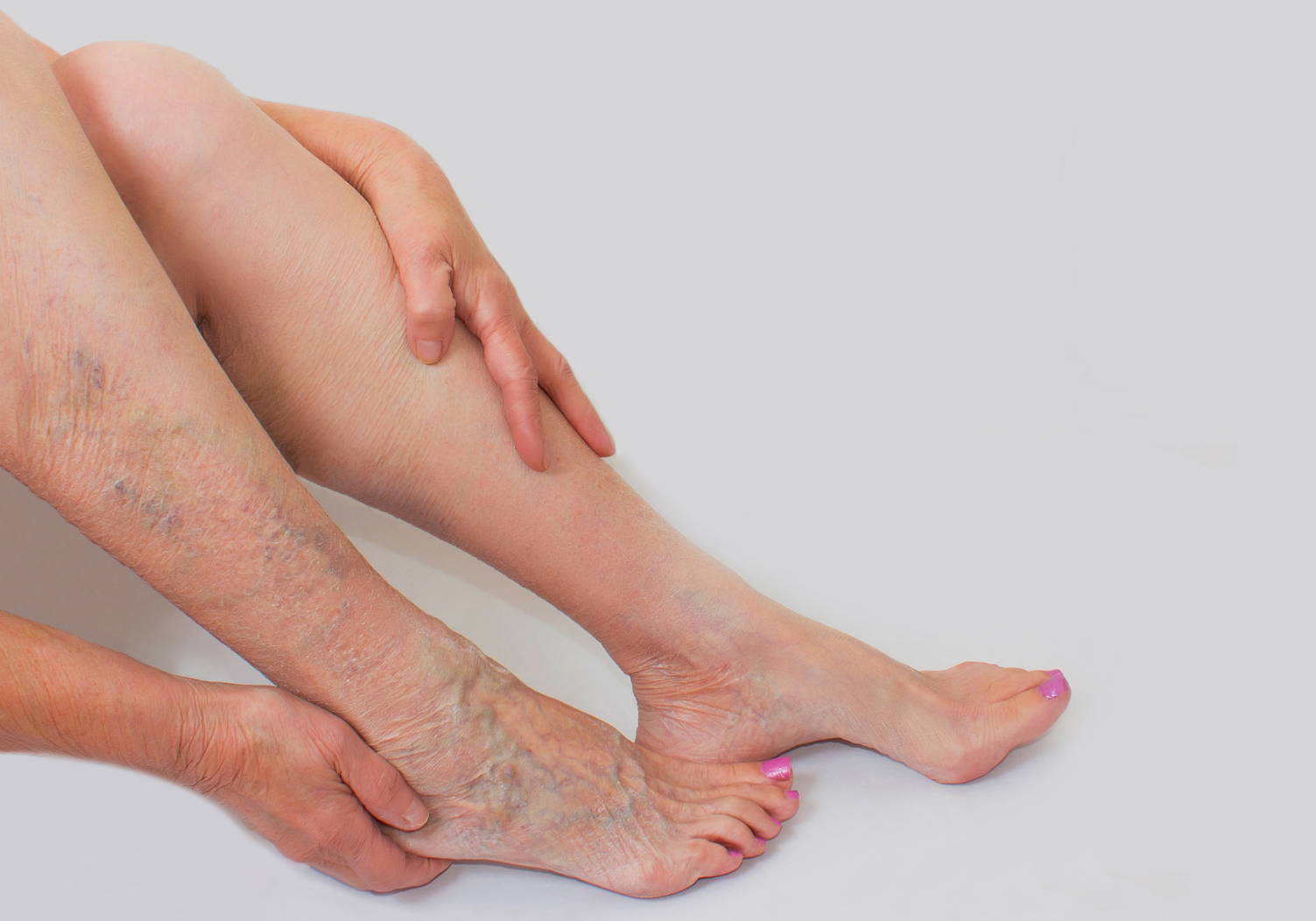 What Are Varicose Veins And How Can They Be Treated Dr Segals