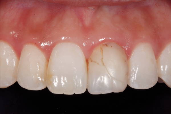 Teeth with crack before polishing
