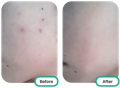 before and after of the cheeks after using the best tea tree oil singapore