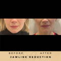 Jaw Line Reduction Wilmslow Dr Sknn Before & After Picture