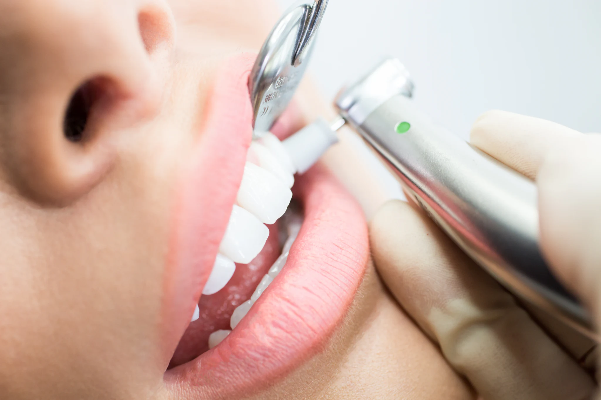 Teeth cleaning
