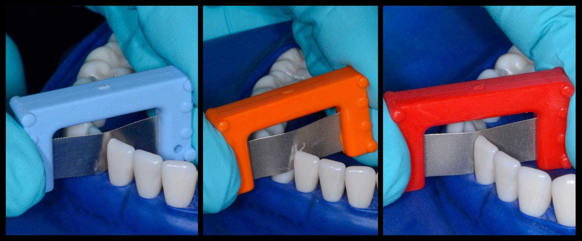 3 images showcasing sanding of teeth