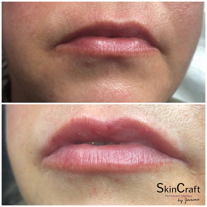 DERMAL FILLERS | Skincraft