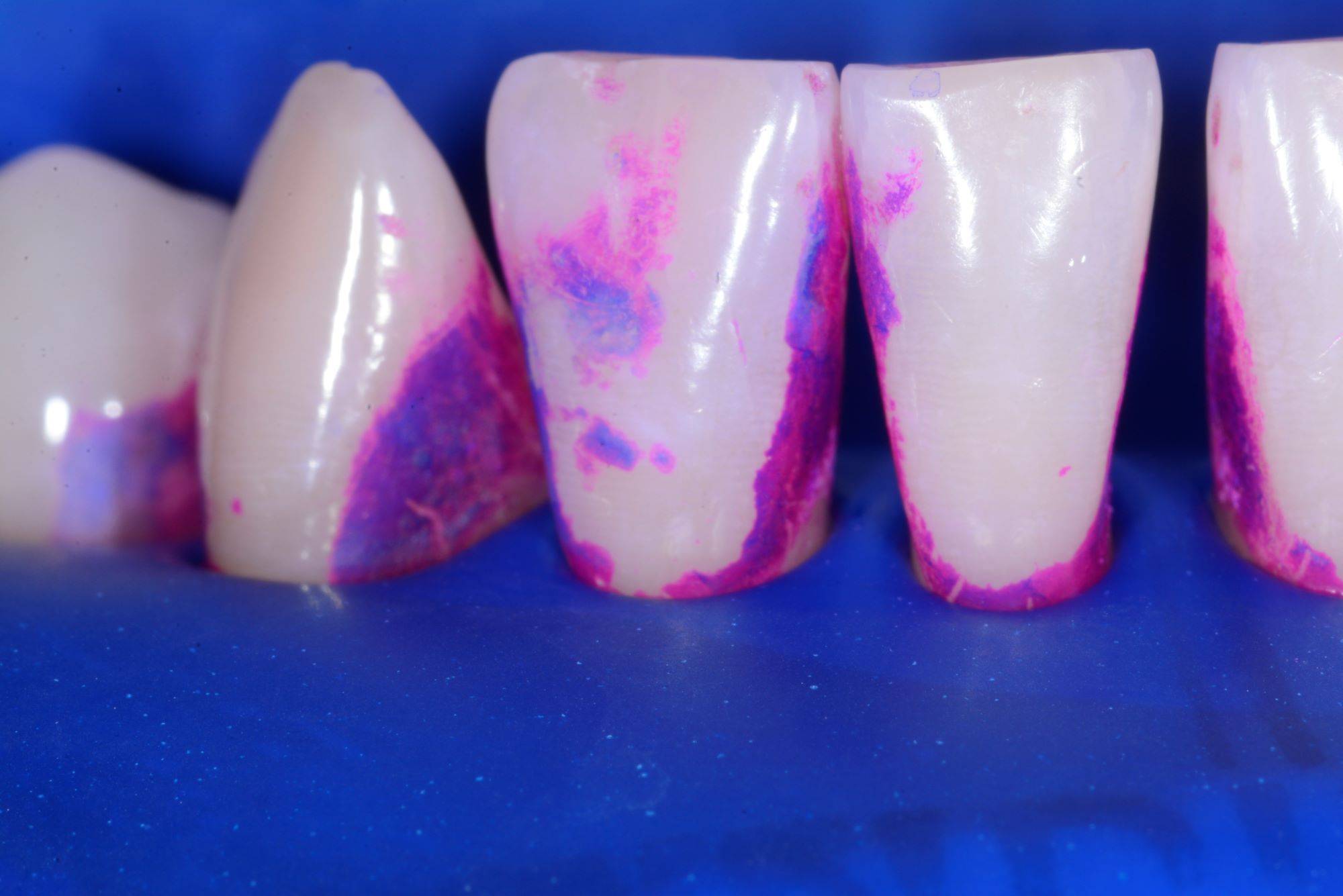 Rubber dam isolated teeth showing purple stains after placement of discloosing solution