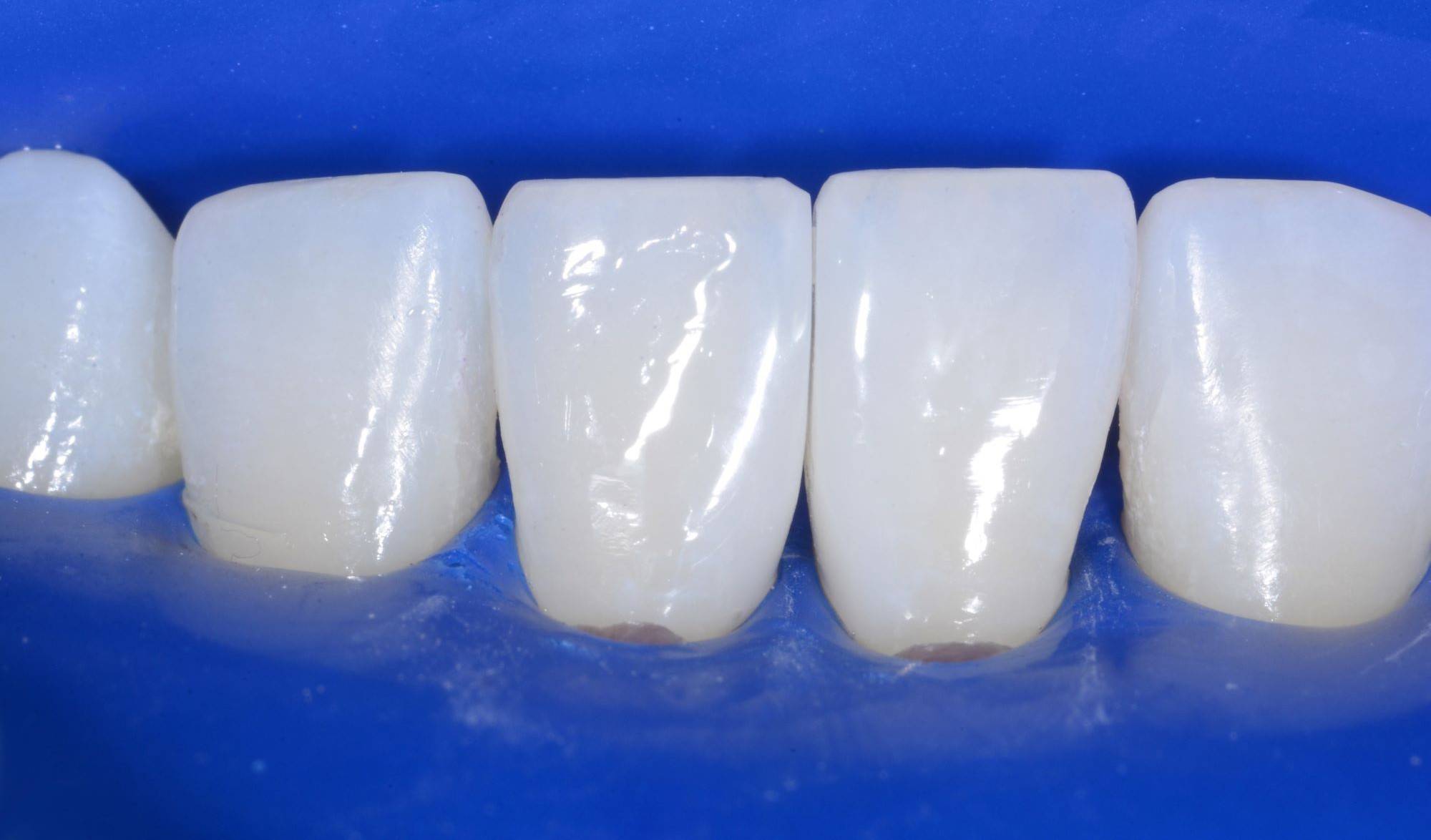 Rubber dam isolated teeth after restoration