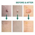 pesky moles & warts treatment