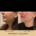 Cheek Fillers Wilmslow