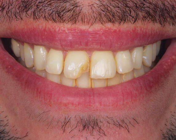 Smile with front tooth in need of restoration