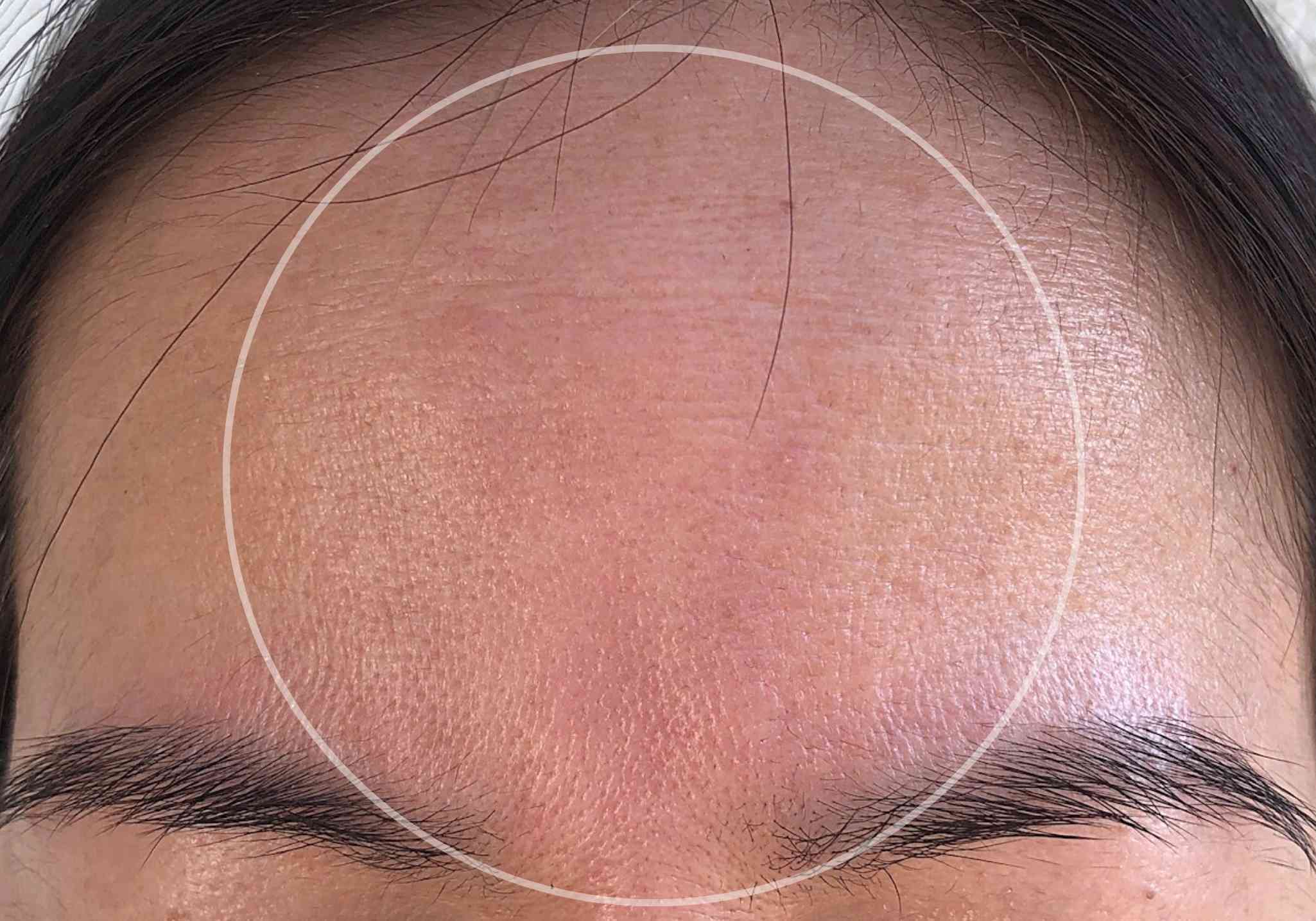 collagen-before-and-after-pictures-wrinkles-forehead-between-eyebrows