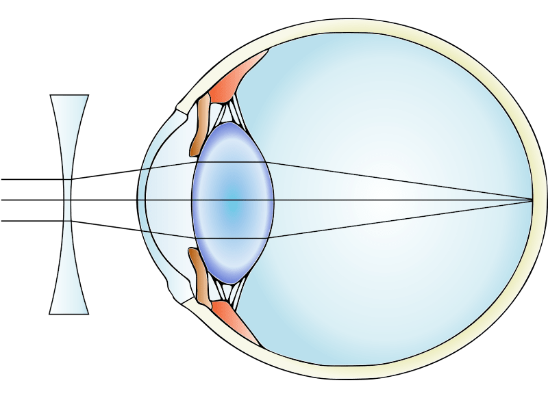 Correcting a nearsighted or myopic eye