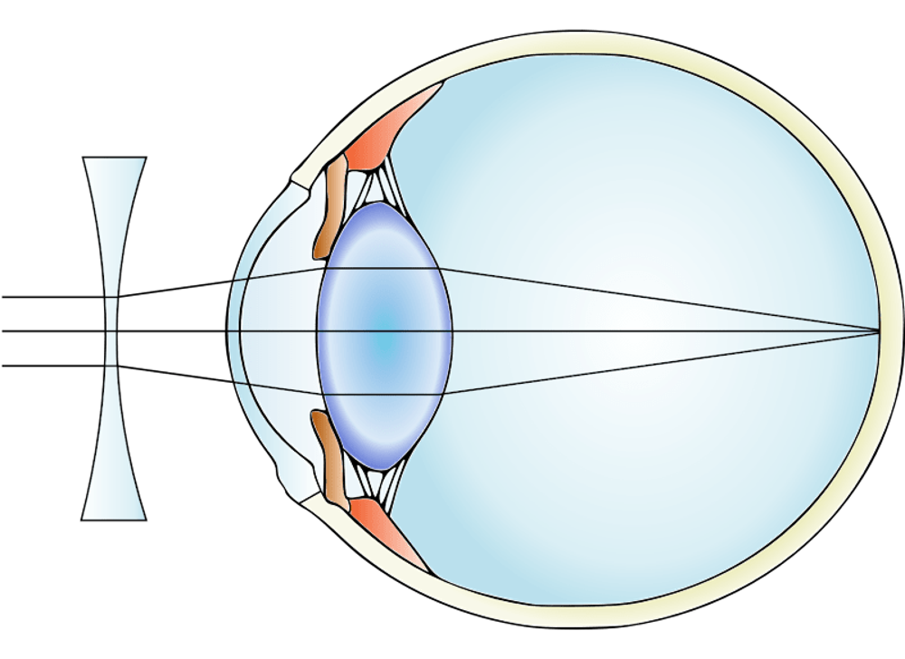 Correcting a short sighted or myopic eye