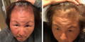Nulastin-Scalp-Hair-Results-Before-After