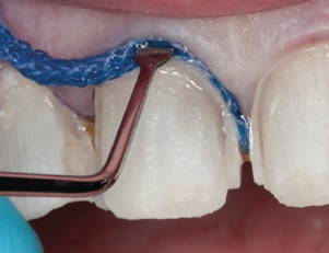 Mastering Retraction Cord Placement Clinical Research Dental