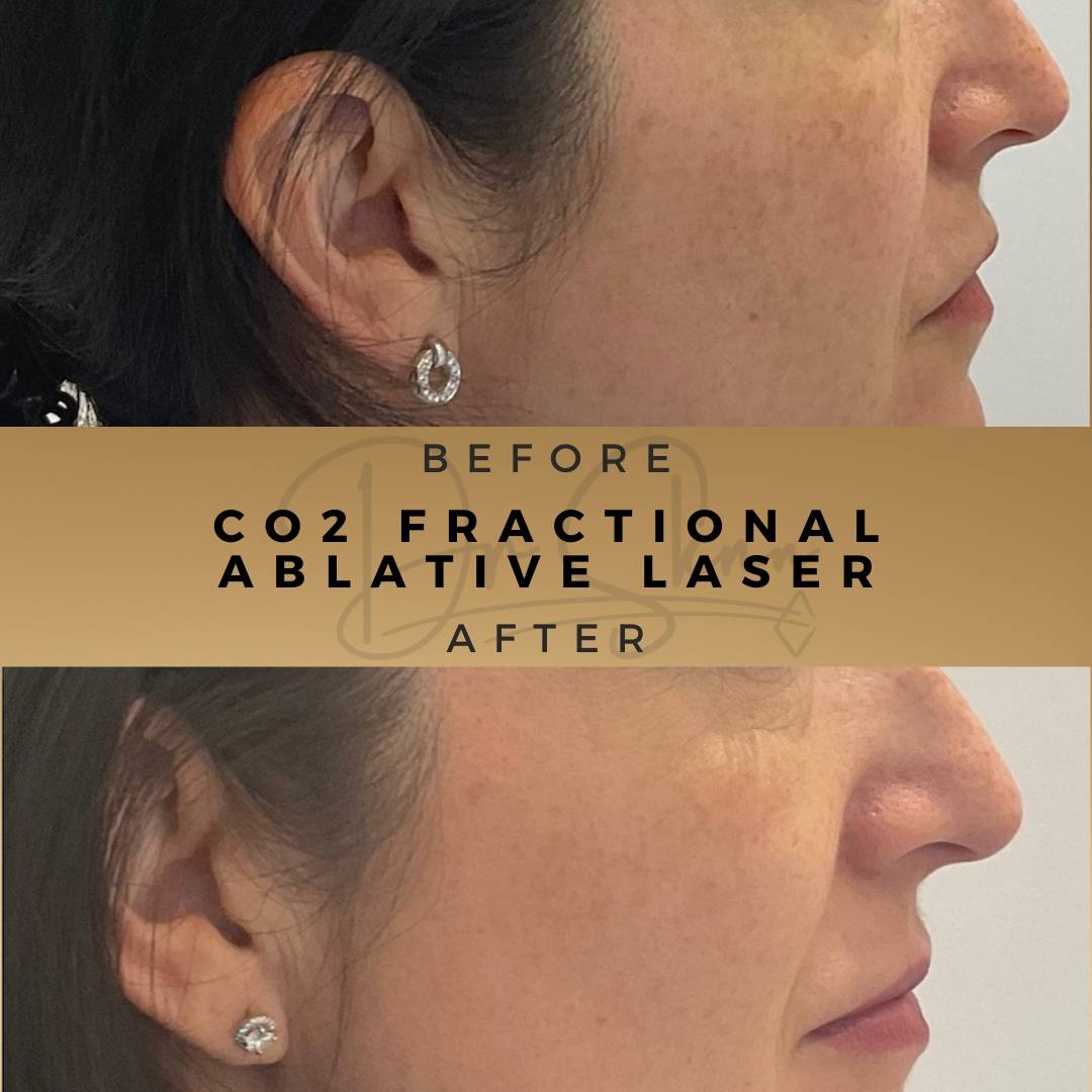 Skin Rejuvenation CO2 Fractional Ablative Laser Wilmslow Before & After Dr Sknn