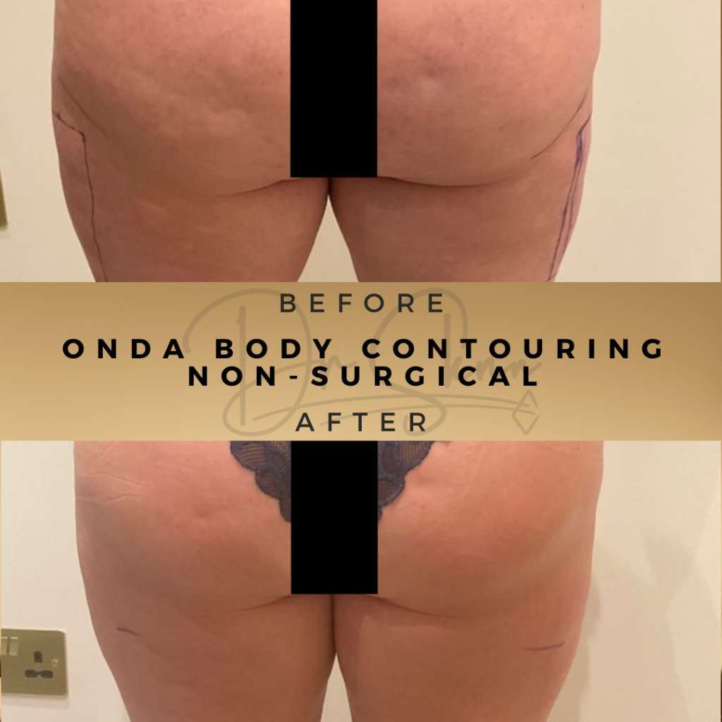 Body Contouring Non Surgical Wilmslow Before & After Pictures Dr Sknn - Onda treatment