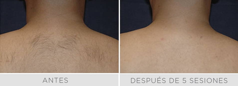 Antes y después de 5 sesiones de depilación láser en cavado