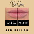 Lip Fillers Wilmslow with Anti-wrinkle injections