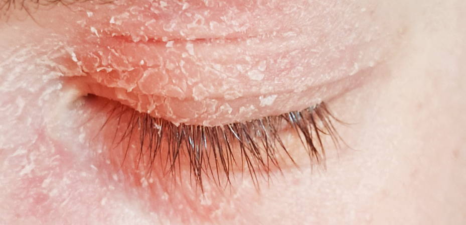 Eyelid eczema before Natural Elements Skincare