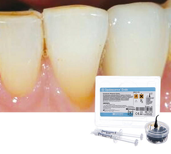 Opalescence Teeth: non-vital tooth bleached with Opalescence endo walking bleach kit