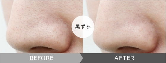くすみ