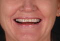 Smile before procedure