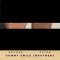 Gummy Smile Correction Fillers Before & After