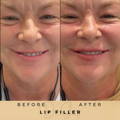 Perioral Line Fillers Wilmslow Before & After