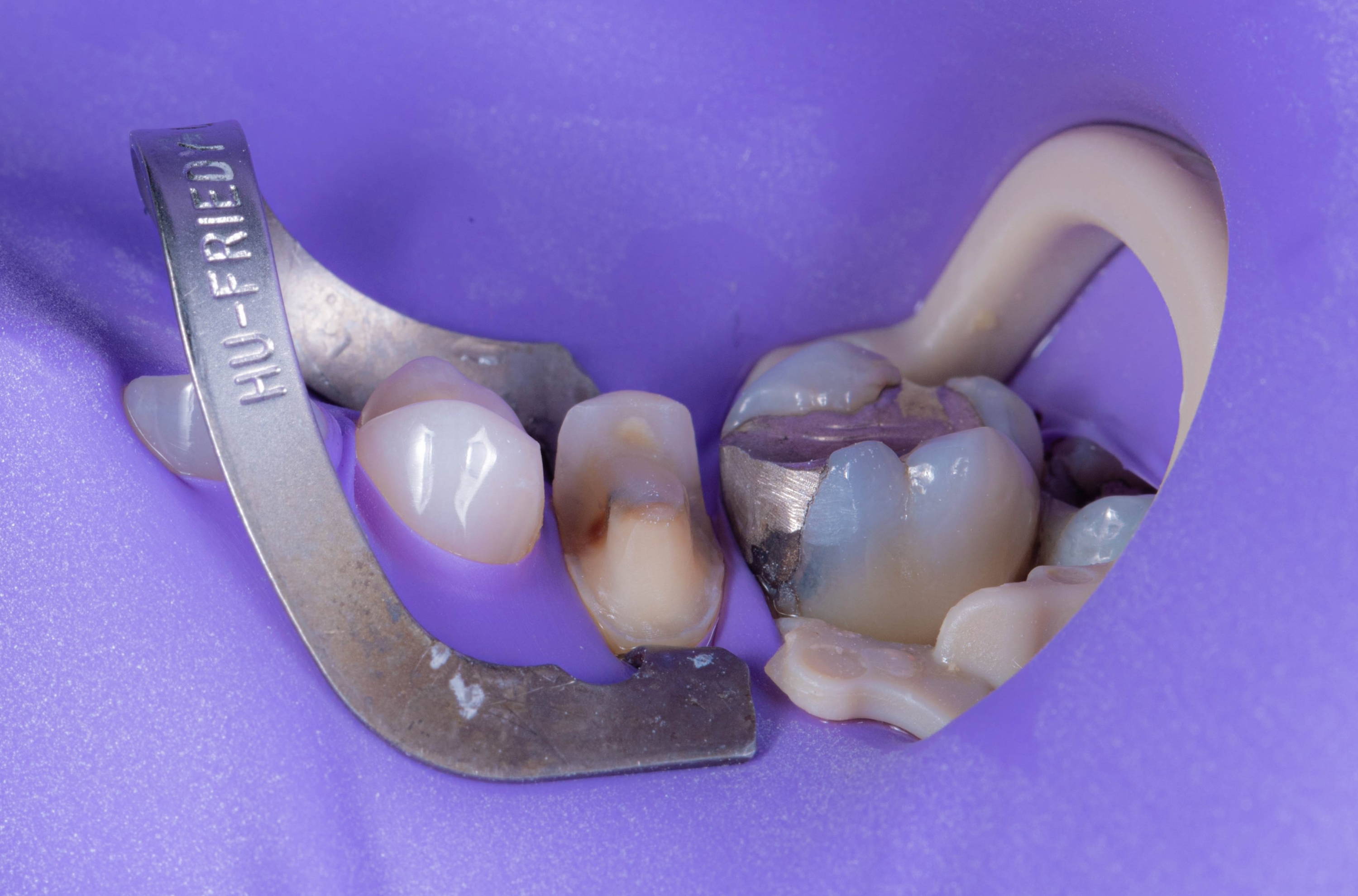 isolated teeth with purple rubber dam undergoing restoration
