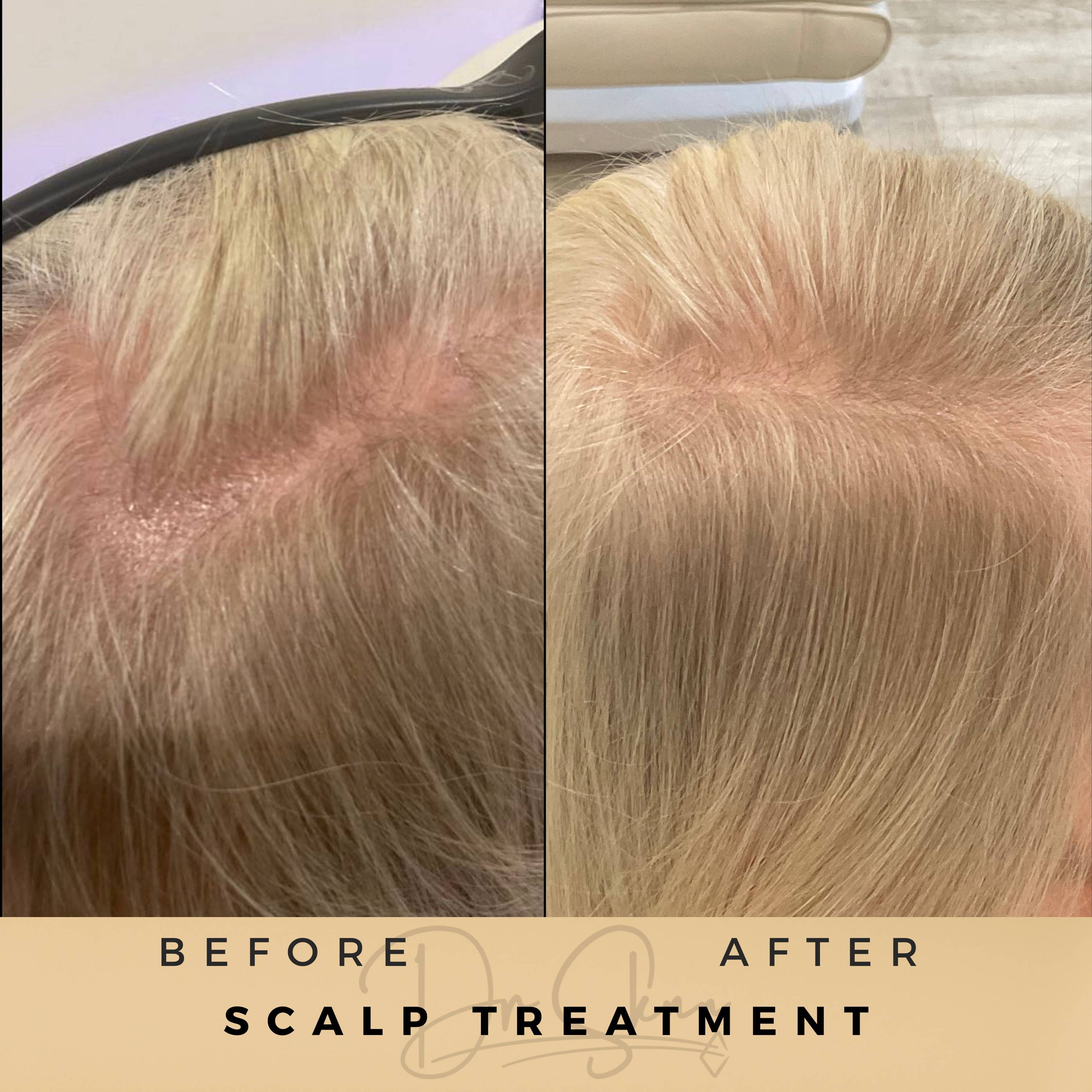 Scalp Treatment Wilmslow Before & After Dr Sknn